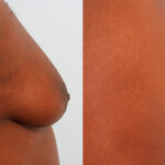 Gynecomastia (Male Breast Reduction) before and after photos in Houston, TX, Patient 28574