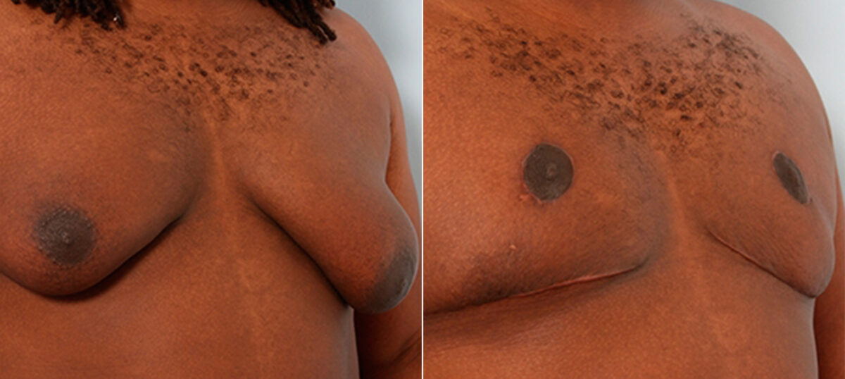 Gynecomastia (Male Breast Reduction) before and after photos in Houston, TX, Patient 28574