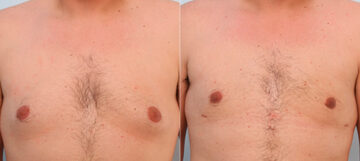 Gynecomastia (Male Breast Reduction) before and after photos in Houston, TX, Patient 28581