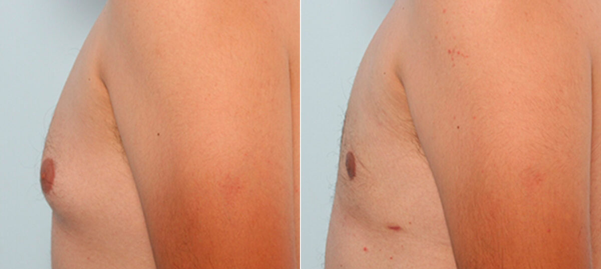 Gynecomastia (Male Breast Reduction) before and after photos in Houston, TX, Patient 28581