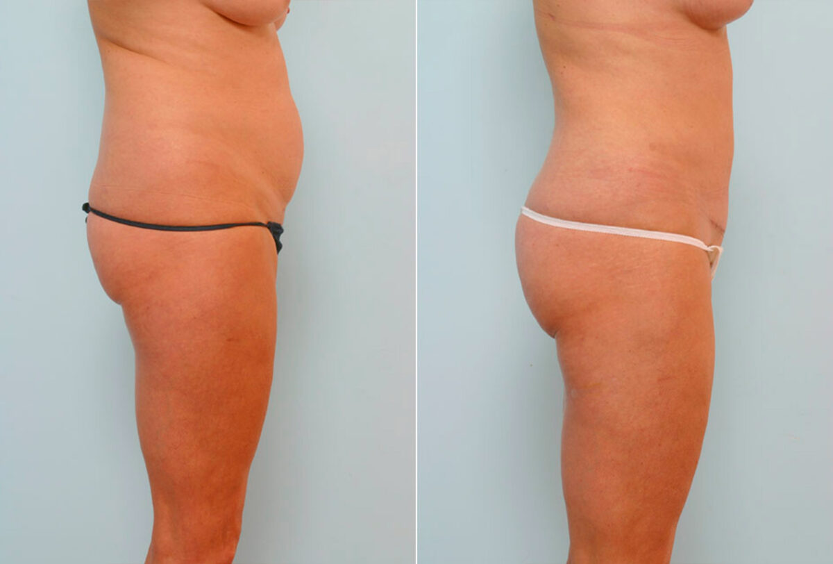 Abdominoplasty before and after photos in Houston, TX, Patient 24633