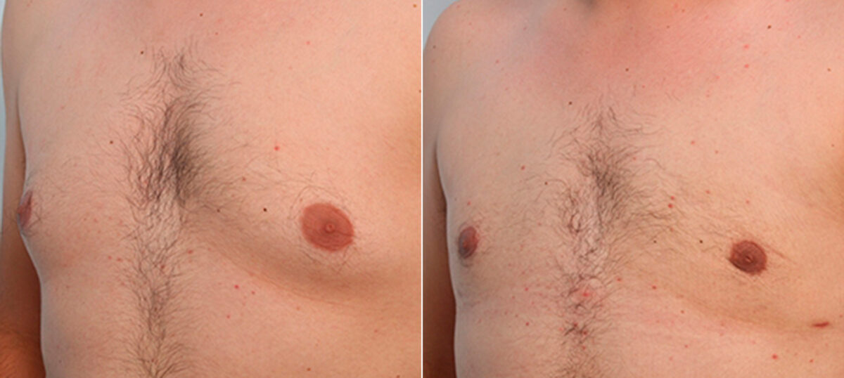 Gynecomastia (Male Breast Reduction) before and after photos in Houston, TX, Patient 28581