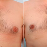 Gynecomastia (Male Breast Reduction) before and after photos in Houston, TX, Patient 28588