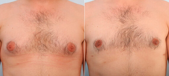 Gynecomastia (Male Breast Reduction) before and after photos in Houston, TX, Patient 28588