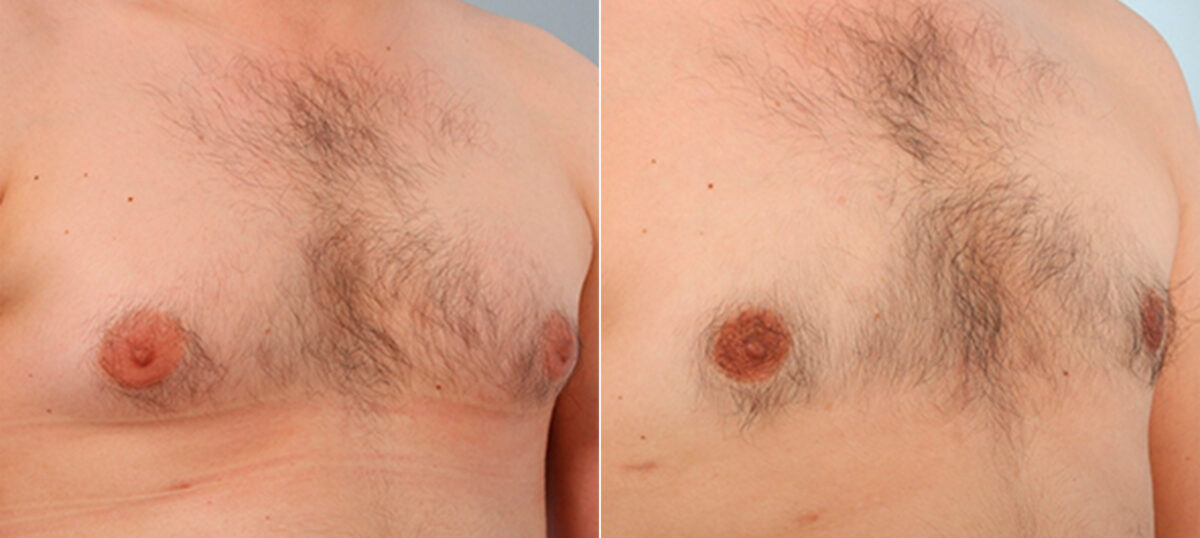 Gynecomastia (Male Breast Reduction) before and after photos in Houston, TX, Patient 28588