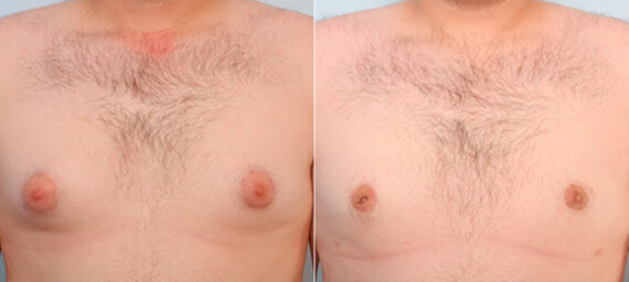 Gynecomastia (Male Breast Reduction) before and after photos in Houston, TX, Patient 28595