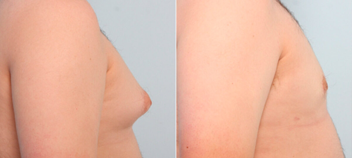 Gynecomastia (Male Breast Reduction) before and after photos in Houston, TX, Patient 28595