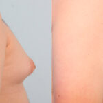 Gynecomastia (Male Breast Reduction) before and after photos in Houston, TX, Patient 28595