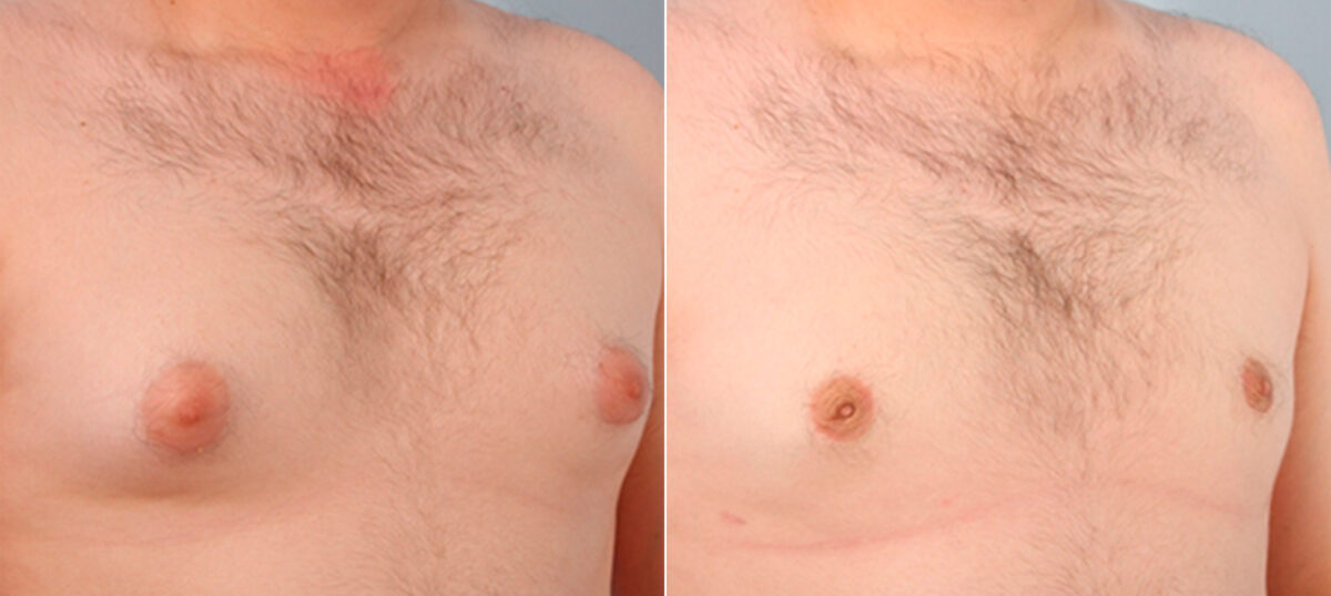 Gynecomastia (Male Breast Reduction) before and after photos in Houston, TX, Patient 28595