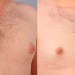Gynecomastia (Male Breast Reduction) before and after photos in Houston, TX, Patient 28595