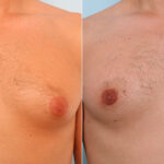 Gynecomastia (Male Breast Reduction) before and after photos in Houston, TX, Patient 28602