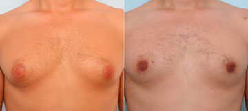 Gynecomastia (Male Breast Reduction) before and after photos in Houston, TX, Patient 28602