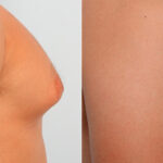 Gynecomastia (Male Breast Reduction) before and after photos in Houston, TX, Patient 28602
