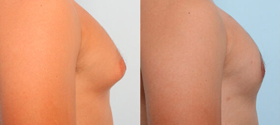 Gynecomastia (Male Breast Reduction) before and after photos in Houston, TX, Patient 28602