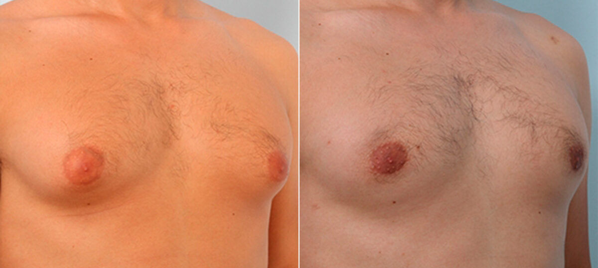 Gynecomastia (Male Breast Reduction) before and after photos in Houston, TX, Patient 28602