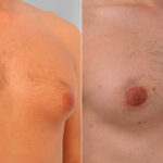 Gynecomastia (Male Breast Reduction) before and after photos in Houston, TX, Patient 28602