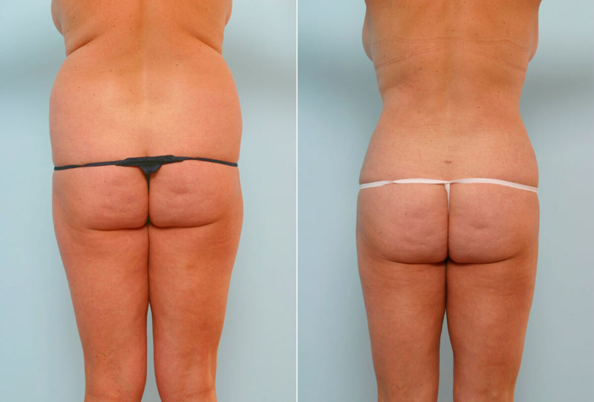 Abdominoplasty before and after photos in Houston, TX, Patient 24633