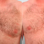 Gynecomastia (Male Breast Reduction) before and after photos in Houston, TX, Patient 28616