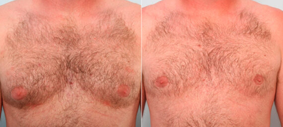 Gynecomastia (Male Breast Reduction) before and after photos in Houston, TX, Patient 28616