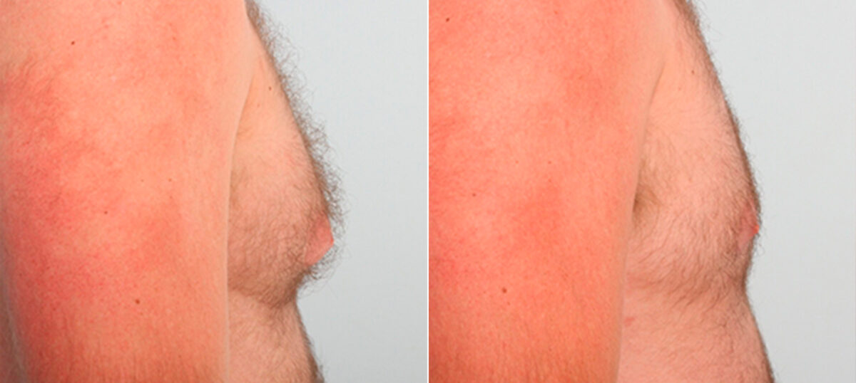 Gynecomastia (Male Breast Reduction) before and after photos in Houston, TX, Patient 28616