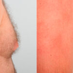 Gynecomastia (Male Breast Reduction) before and after photos in Houston, TX, Patient 28616