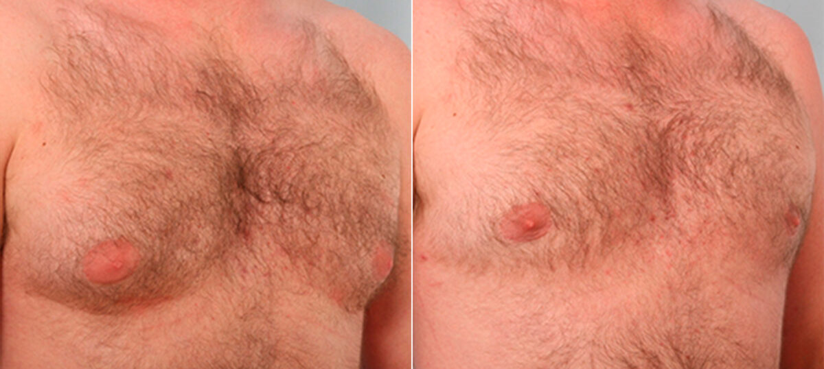 Gynecomastia (Male Breast Reduction) before and after photos in Houston, TX, Patient 28616