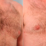 Gynecomastia (Male Breast Reduction) before and after photos in Houston, TX, Patient 28616