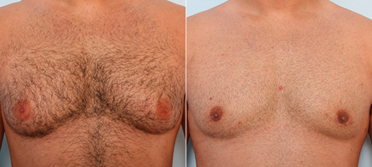 Gynecomastia (Male Breast Reduction) before and after photos in Houston, TX, Patient 28623