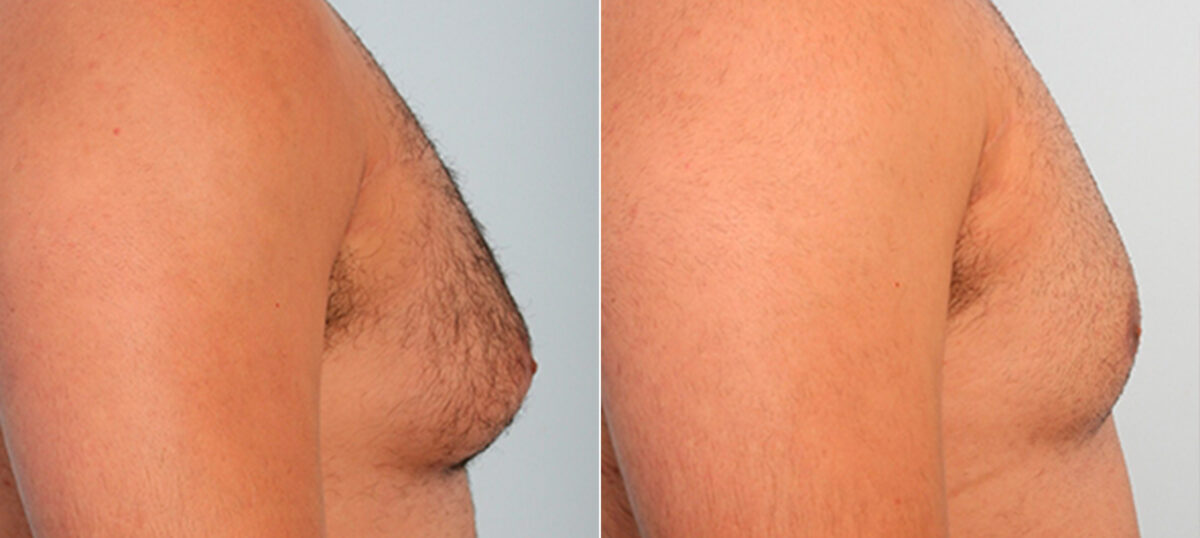 Gynecomastia (Male Breast Reduction) before and after photos in Houston, TX, Patient 28623