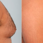 Gynecomastia (Male Breast Reduction) before and after photos in Houston, TX, Patient 28623