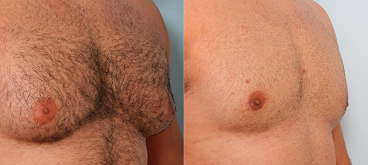 Gynecomastia (Male Breast Reduction) before and after photos in Houston, TX, Patient 28623