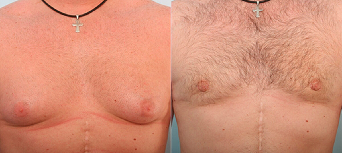 Gynecomastia (Male Breast Reduction) before and after photos in Houston, TX, Patient 28630