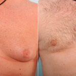 Gynecomastia (Male Breast Reduction) before and after photos in Houston, TX, Patient 28630