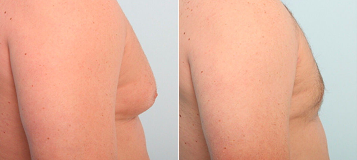 Gynecomastia (Male Breast Reduction) before and after photos in Houston, TX, Patient 28630