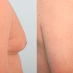 Gynecomastia (Male Breast Reduction) before and after photos in Houston, TX, Patient 28630