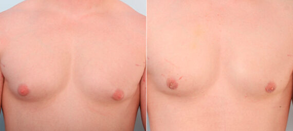 Gynecomastia (Male Breast Reduction) before and after photos in Houston, TX, Patient 28639