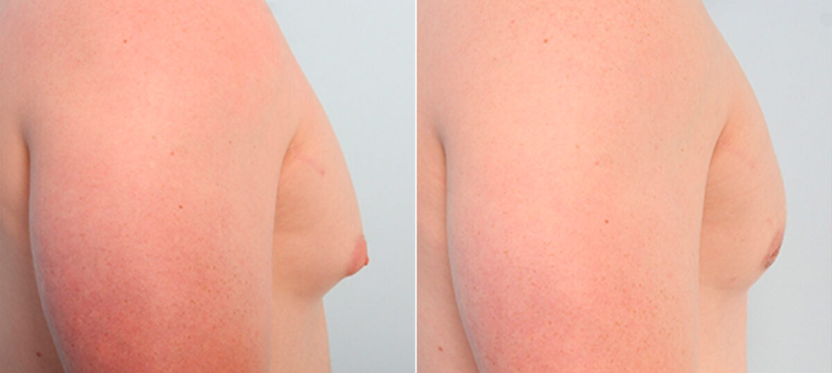 Gynecomastia (Male Breast Reduction) before and after photos in Houston, TX, Patient 28639