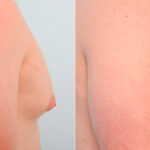 Gynecomastia (Male Breast Reduction) before and after photos in Houston, TX, Patient 28639