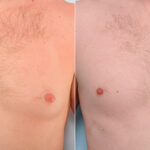 Gynecomastia (Male Breast Reduction) before and after photos in Houston, TX, Patient 28646