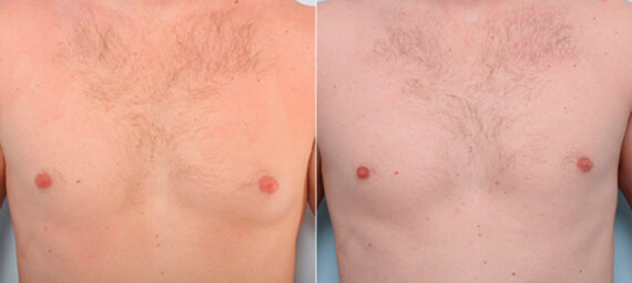 Gynecomastia (Male Breast Reduction) before and after photos in Houston, TX, Patient 28646