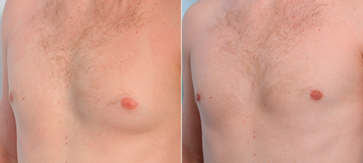 Gynecomastia (Male Breast Reduction) before and after photos in Houston, TX, Patient 28646