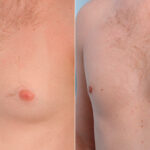 Gynecomastia (Male Breast Reduction) before and after photos in Houston, TX, Patient 28646