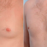 Gynecomastia (Male Breast Reduction) before and after photos in Houston, TX, Patient 28646