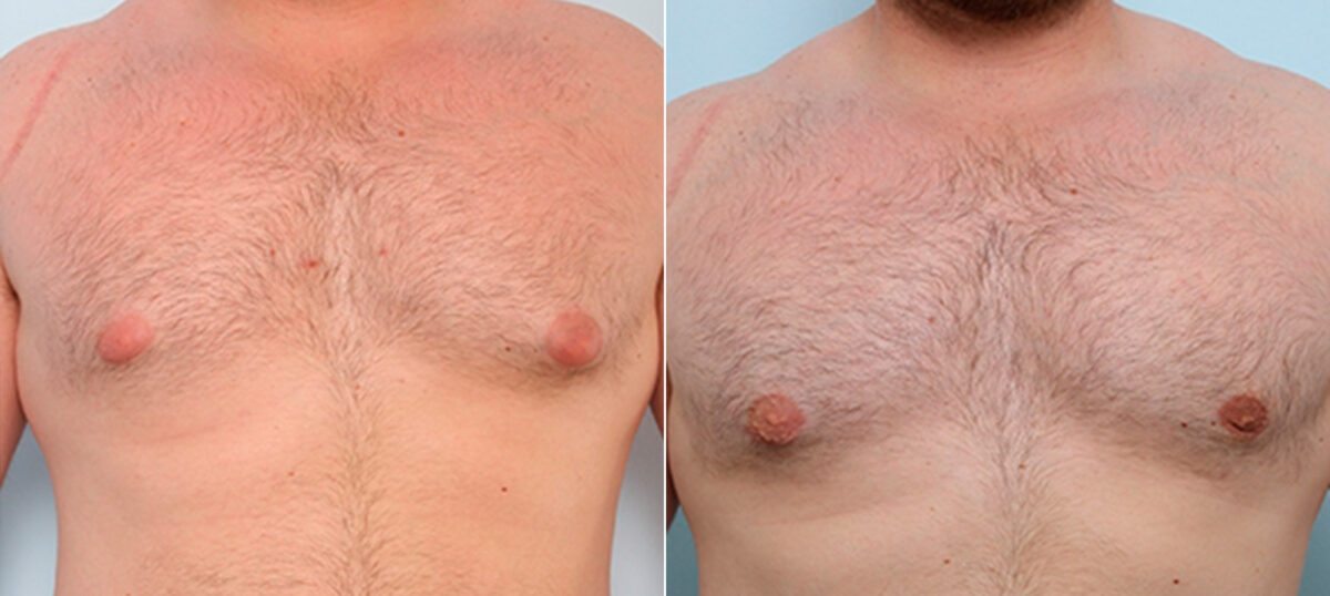 Gynecomastia (Male Breast Reduction) before and after photos in Houston, TX, Patient 28660