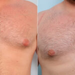 Gynecomastia (Male Breast Reduction) before and after photos in Houston, TX, Patient 28660