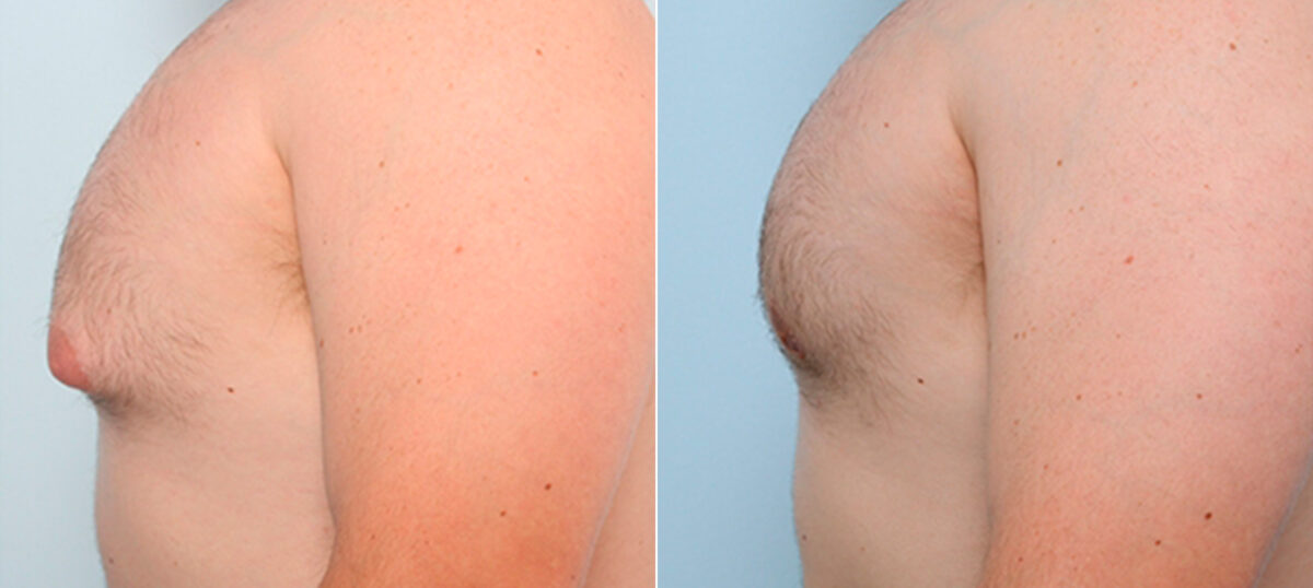 Gynecomastia (Male Breast Reduction) before and after photos in Houston, TX, Patient 28660