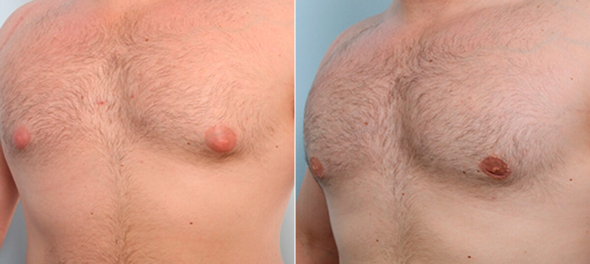 Gynecomastia (Male Breast Reduction) before and after photos in Houston, TX, Patient 28660