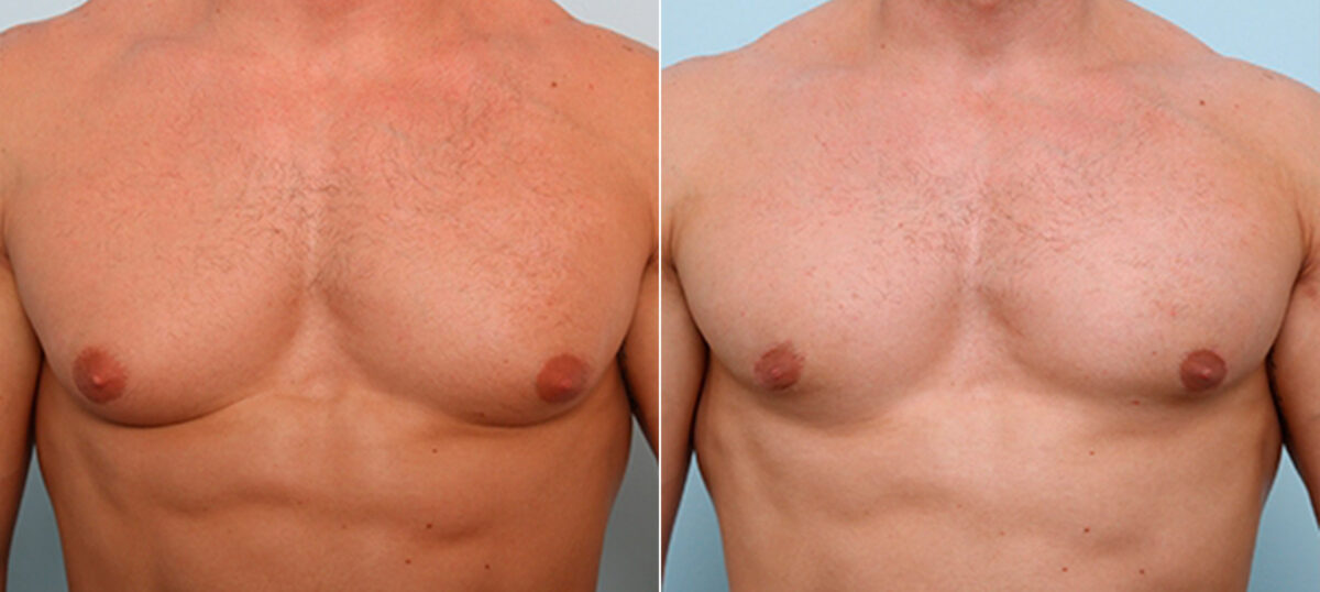 Gynecomastia (Male Breast Reduction) before and after photos in Houston, TX, Patient 28674