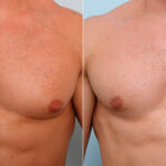 Gynecomastia (Male Breast Reduction) before and after photos in Houston, TX, Patient 28674