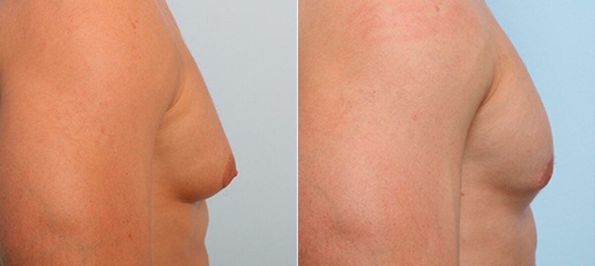 Gynecomastia (Male Breast Reduction) before and after photos in Houston, TX, Patient 28674